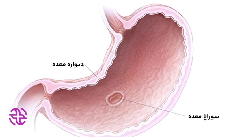 سوراخ شدن معده باعث بیماری میشه