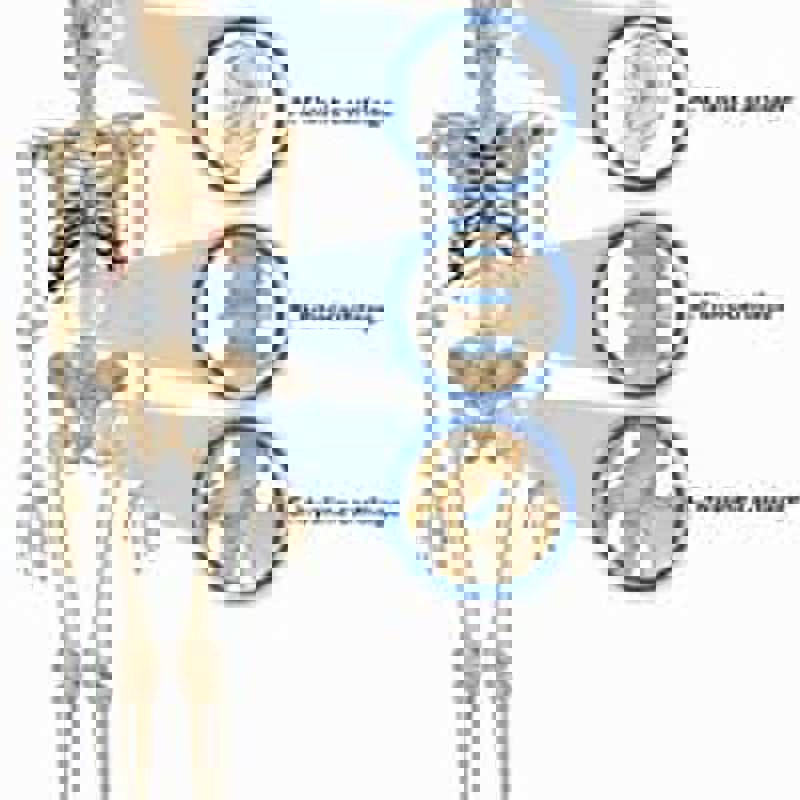 آرتروز یا استئوآرتریت یکی از شایع‌ترین بیماری‌های مفاصل است که می‌تواند هر مفصلی در بدن را درگیر کند