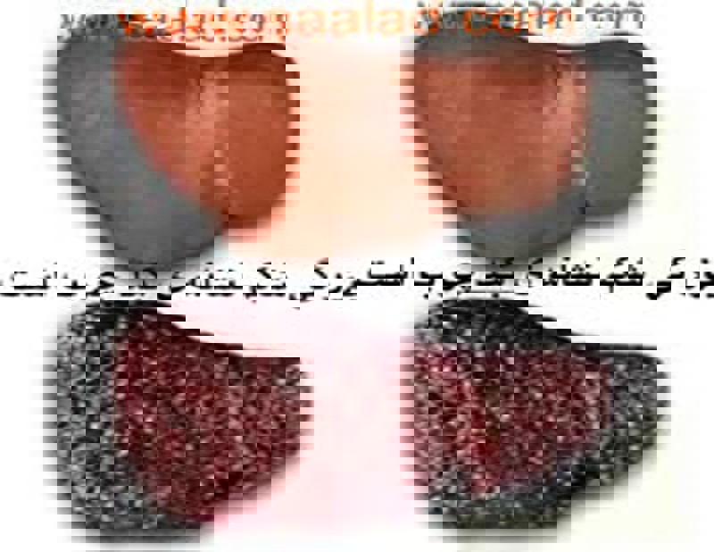 نوشیدن آب یخ و کبد چرب