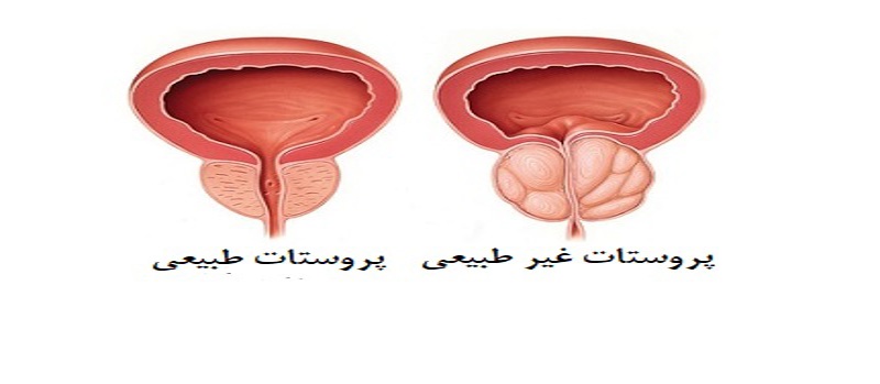 بزرگی پرستات و اثر آن بر مغزانسان